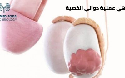 عملية دوالي الخصية بالتفاصيل ومتى تحتاج اليها