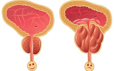 نصائح بعد استئصال البروستاتا وتجربتي مع استئصال البروستاتا