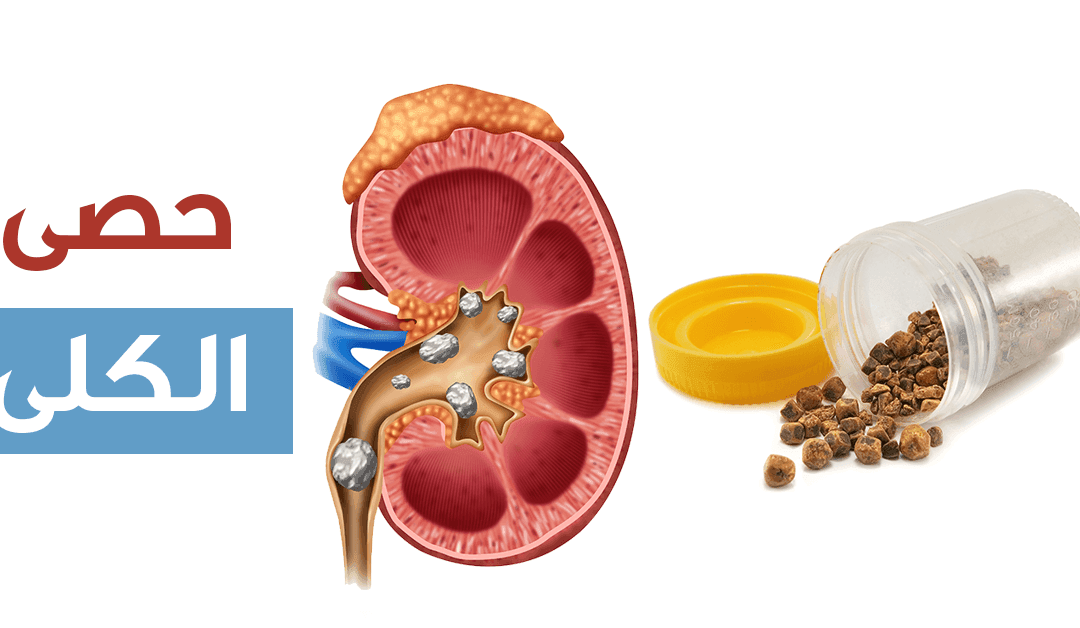 أعراض حصوات الكلى