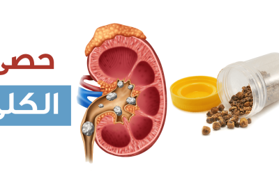 أعراض حصوات الكلى