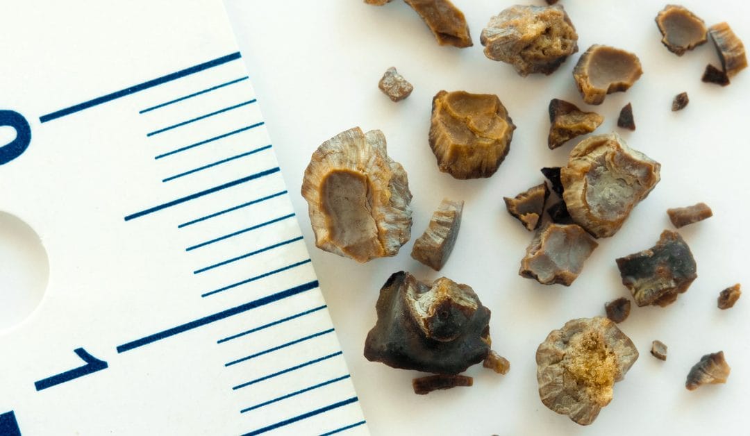 أعراض حصى المثانة