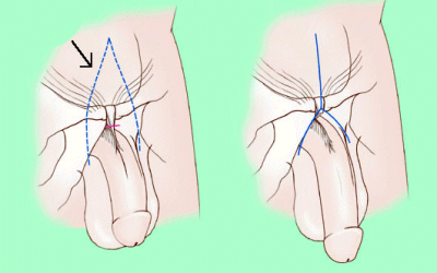جراحة تكبير القضيب