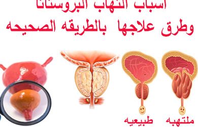 أعراض التهاب البروستاتا