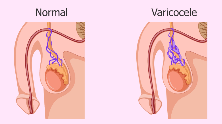 اسباب دوالي الخصية 2 أشهر أسباب دوالي الخصية