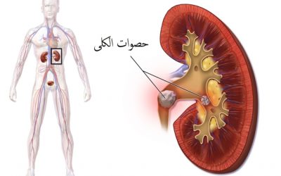 كيفية تفتيت حصوات الكلى بسرعة
