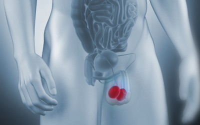 هل دوالي الخصية خطيرة؟