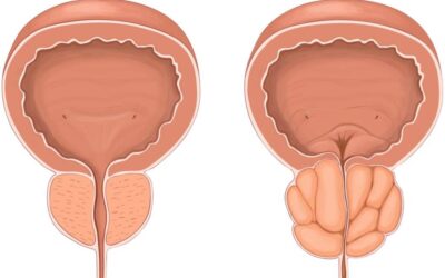 تكلفة استئصال البروستاتا بالمنظار – جراحة البروستاتا بالليزر