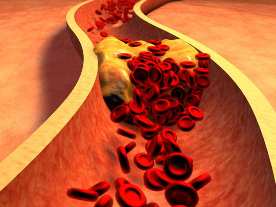 علاج التسرب الوريدي بسبب العادة مع الدكتور احمد فودة 2 ما هي أشهر الأعراض المرضية الناتجة عن مشكلة التسرب الوريدي