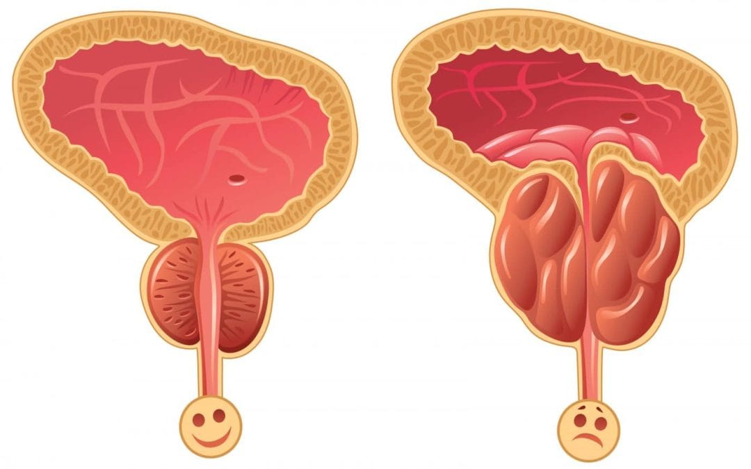 الفرق بين سرطان البروستاتا وتضخم البروستاتا