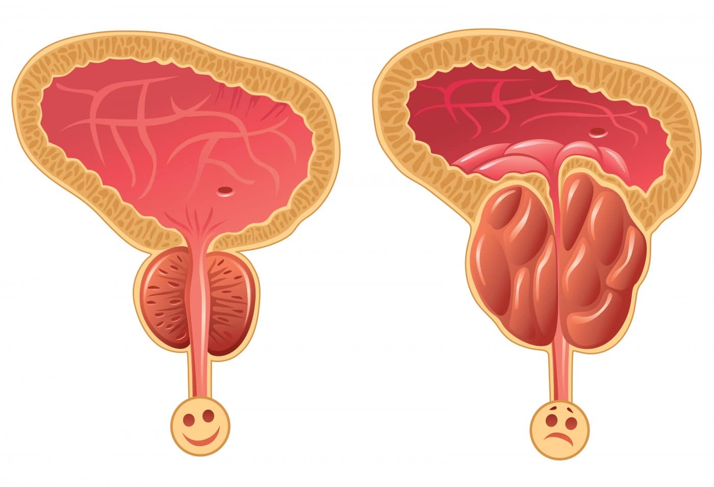 تضخم البروستات