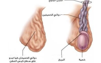عملية دوالي الخصيتين