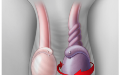 عملية لعلاج انكماش كيس الصفن