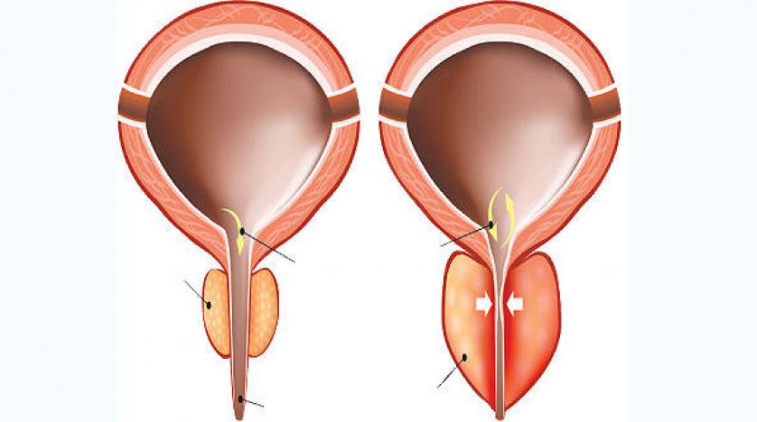 أسباب تضخم البروستاتا 3 أسباب تضخم البروستاتا