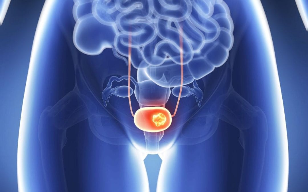 التهاب المثانة عند الرجال