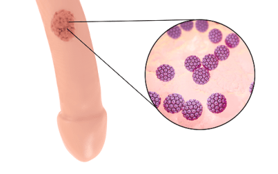 الهربس التناسلي عند الرجال وكيفية علاجه وتجنب مضاعفاته