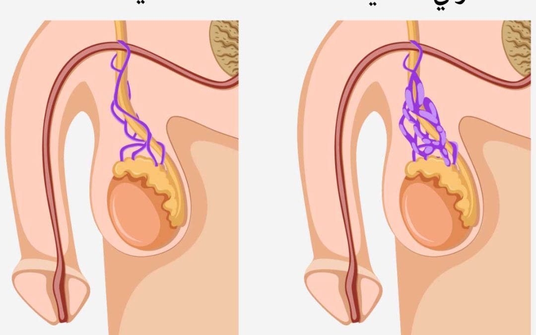كيفية معرفة دوالي الخصية
