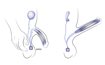 تركيب دعامات للعضو الذكري كل ما تريد معرفته عن عملية الدعامة للانتصاب