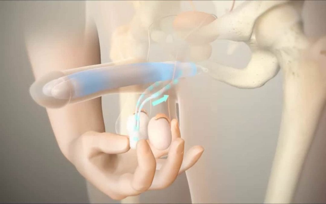 دعامة العضو الذكري لعلاج الضعف الجنسي – علاج الانتصاب