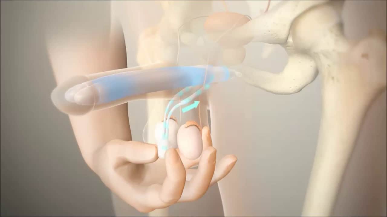 دعامة الانتصاب دعامة الانتصاب