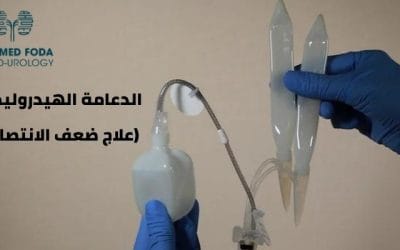 الدعامة الهيدروليكية (أهم علاج ضعف الانتصاب)