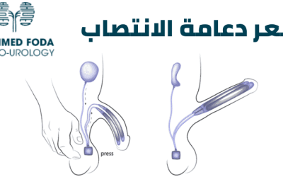 سعر دعامة القضيب – تكلفة دعامة العضو الذكري في مصر