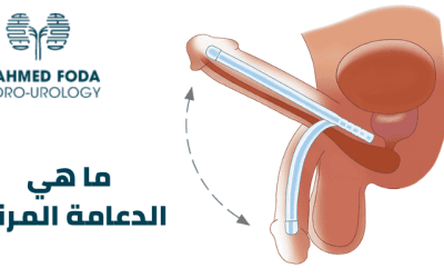 الدعامة المرنة – علاج ضعف الانتصاب