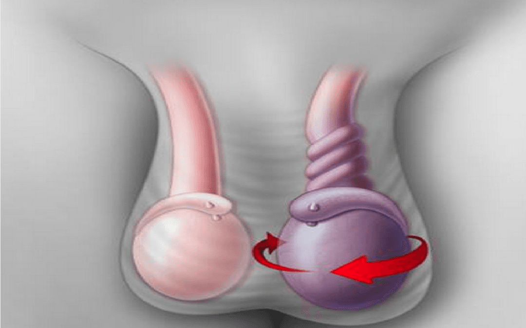التواء الخصية