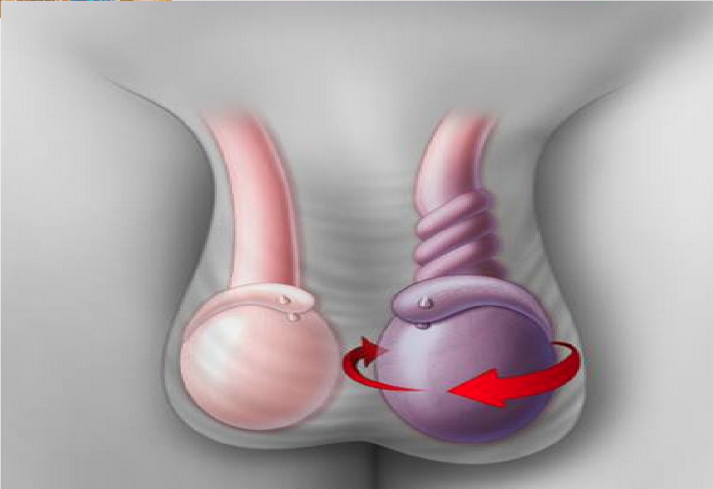 التواء الخصية
