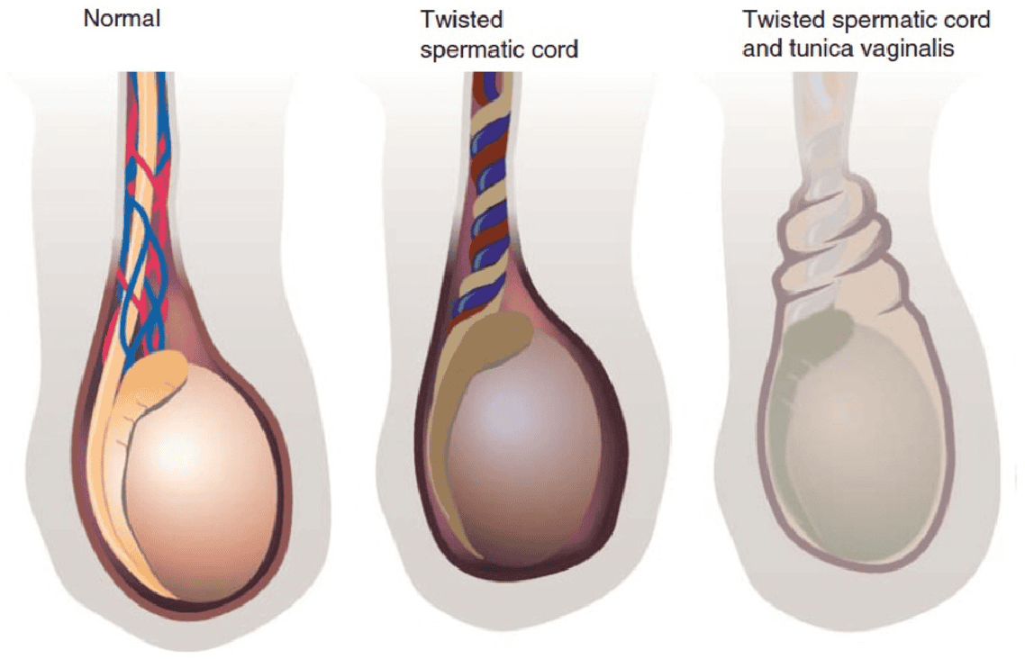 التواء الخصية