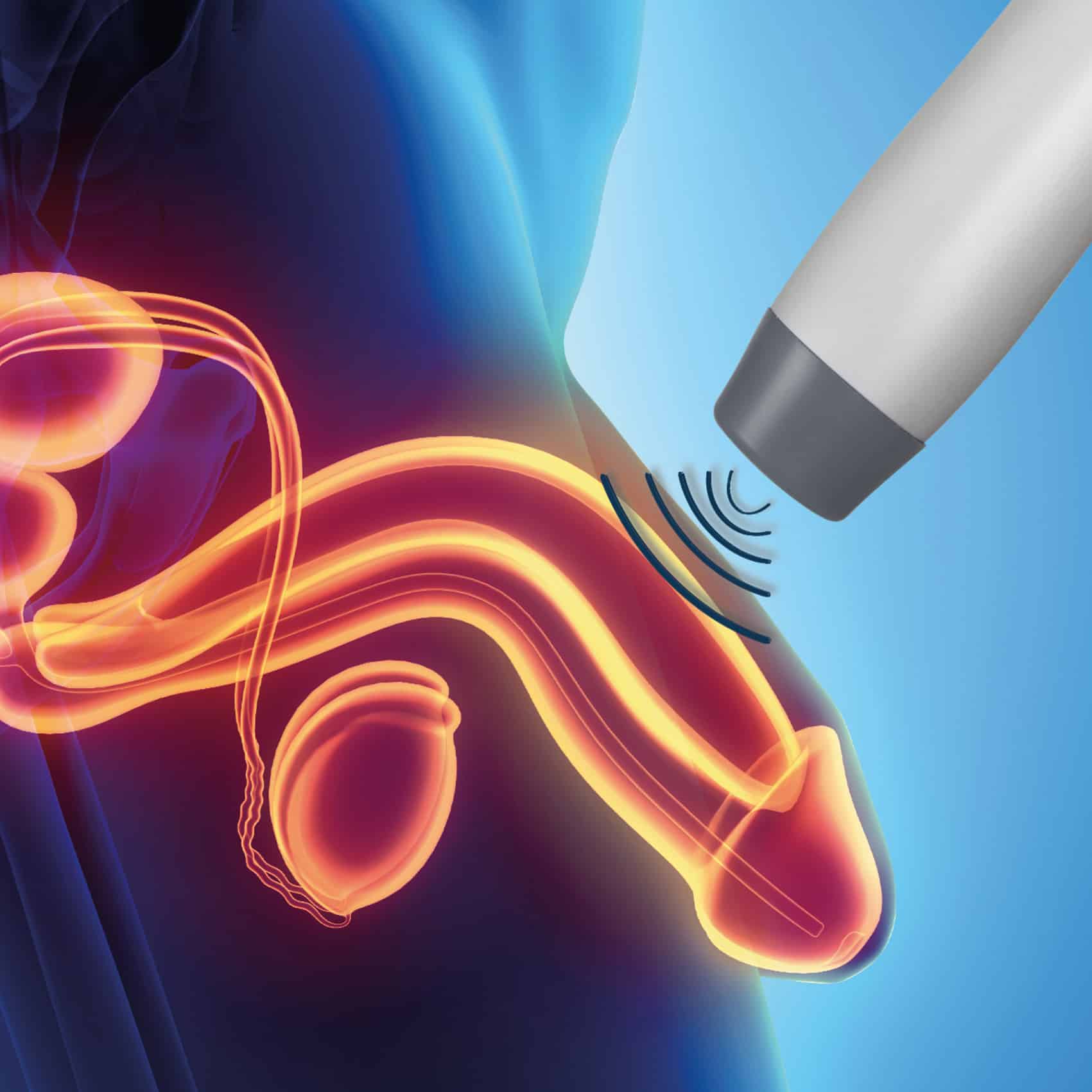 سعر جهاز الانتصاب . سعر جهاز الانتصاب