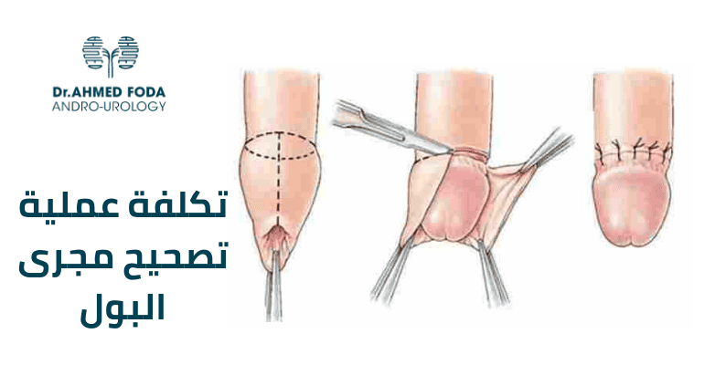 تكلفة عملية تصحيح مجرى البول - تكلفة عملية الإحليل السفلي في مصر - عملية الإحليل السفلي للاطفال