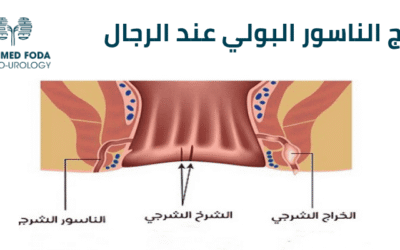 علاج الناسور البولي عند الرجال