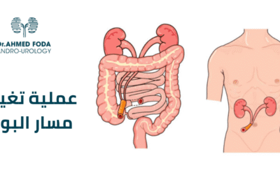 عملية تغيير مسار البول