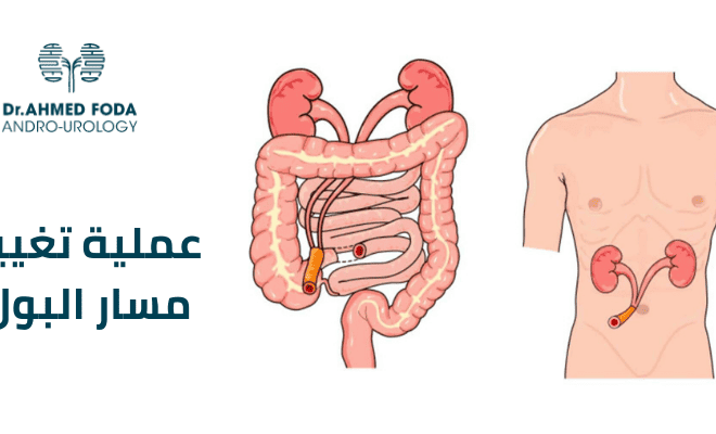 عملية تغيير مسار البول