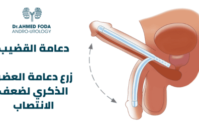 زرع دعامة العضو الذكري لضعف الانتصاب