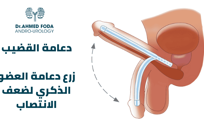دعامة العضو الذكري | عملية دعامة القضيب | علاج ضعف الانتصاب