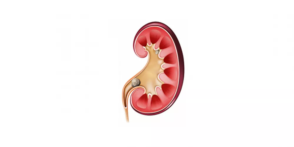 أعراض نزول الحصوة مع البول وكيفية علاجها دون ألم؟ 2 أعراض نزول الحصوة مع البول