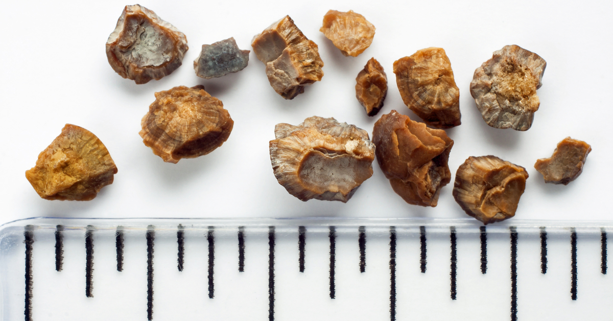 أعراض نزول الحصوة مع البول وكيفية علاجها دون ألم؟ 4 أنواع حصوات الكلى