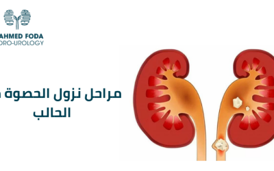 مراحل نزول الحصوة من الحالب