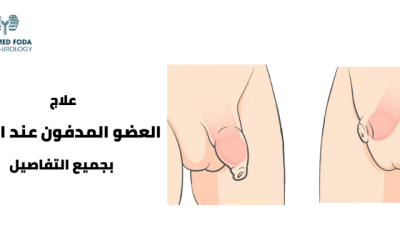 علاج العضو المدفون عند الرضع