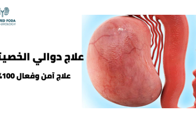 علاج دوالي الخصيتين نهائياً