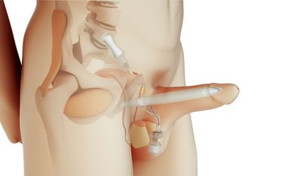الدعامات الهيدروليكية – الأنواع والمميزات وتفاصيل تركيب دعامة القضيب