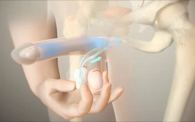 متى يختفي الألم بعد تركيب الدعامات؟ وكيف يتم الحفاظ على الصحة بعد العملية؟